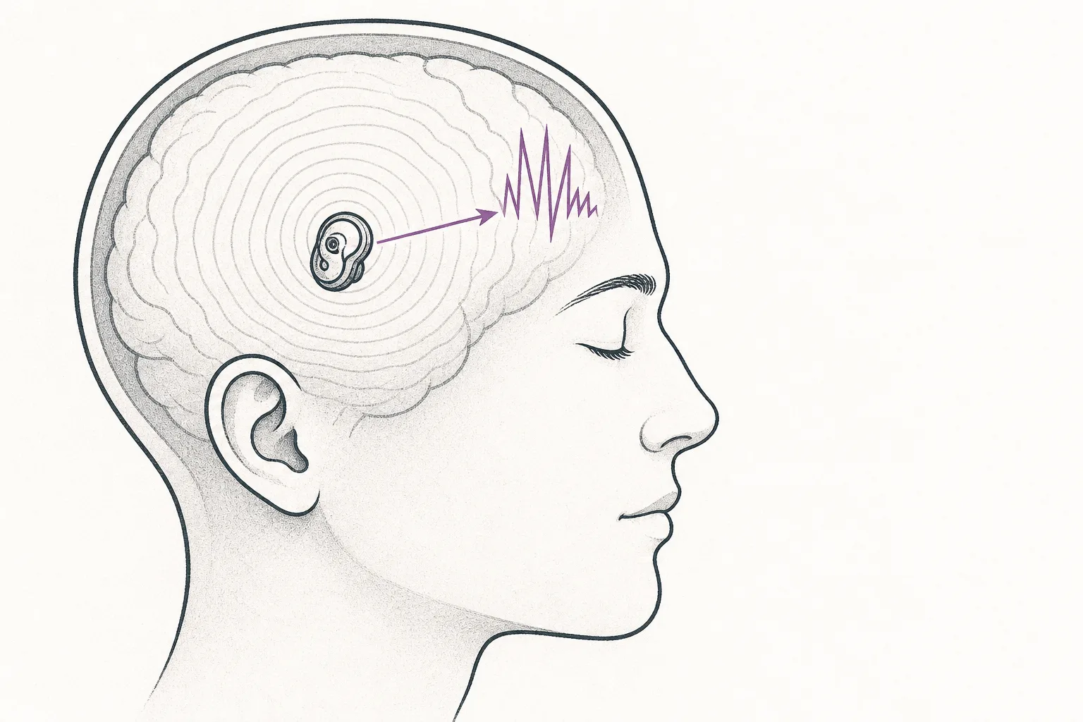A person sitting calmly, with a small device in the brain that has ears constantly listening to the brainwaves. When it catches an abnormal signal, it sends a single pulse back in to head it off — representing a device that listens first and stimulates only when needed.